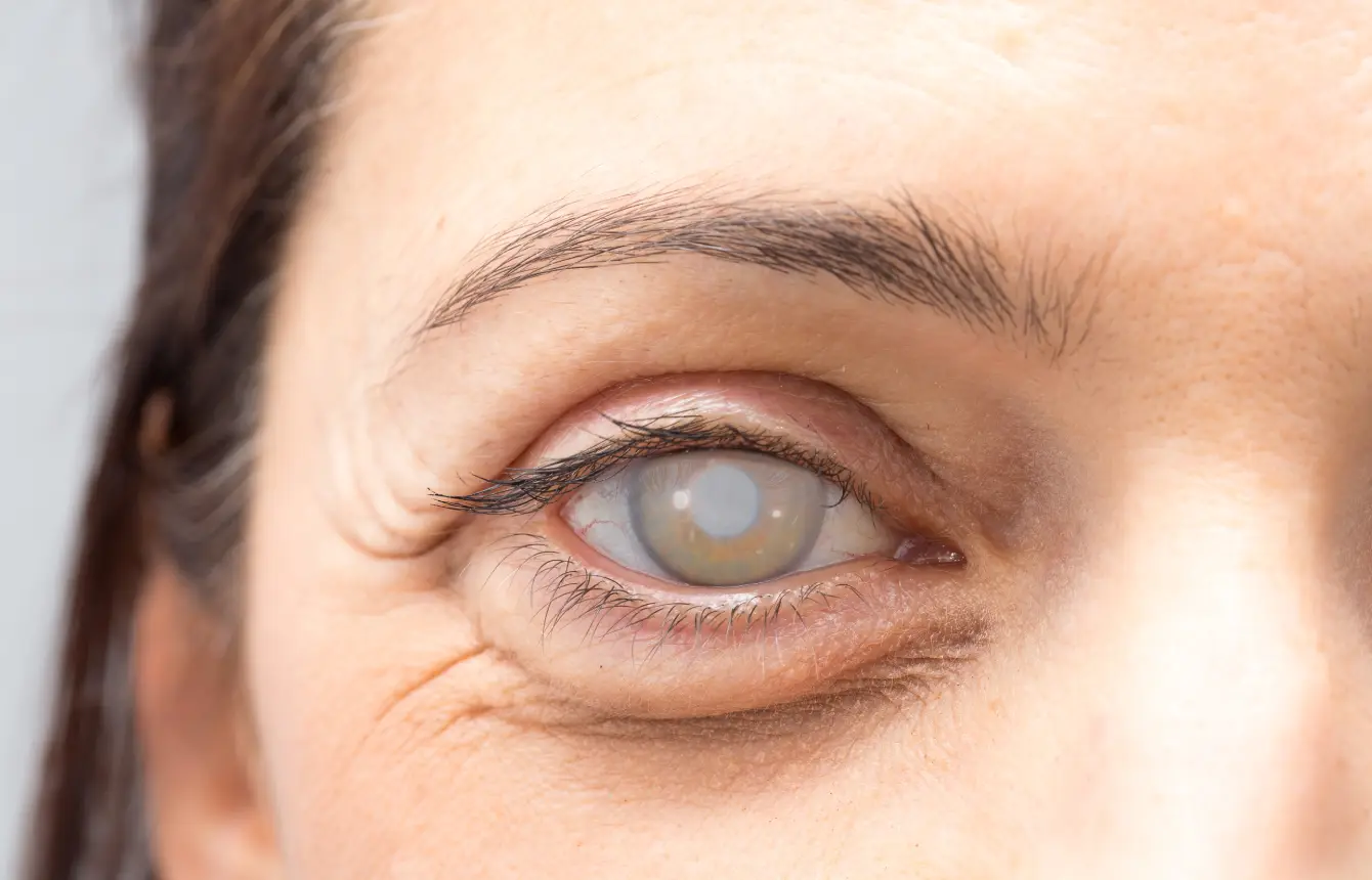 Cirugía de catarata